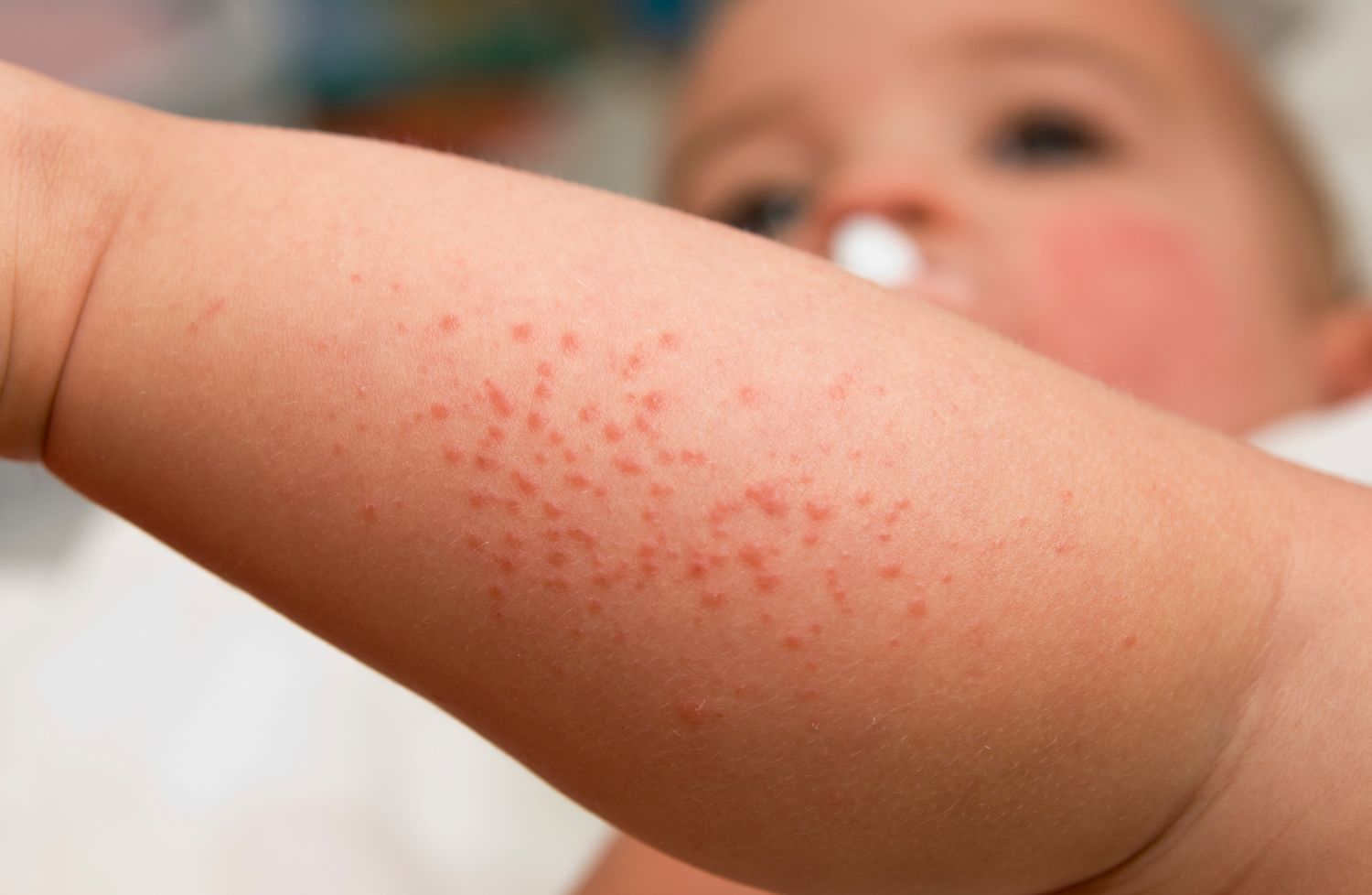 Bouton de chaleur bébé : causes, symptômes et solutions